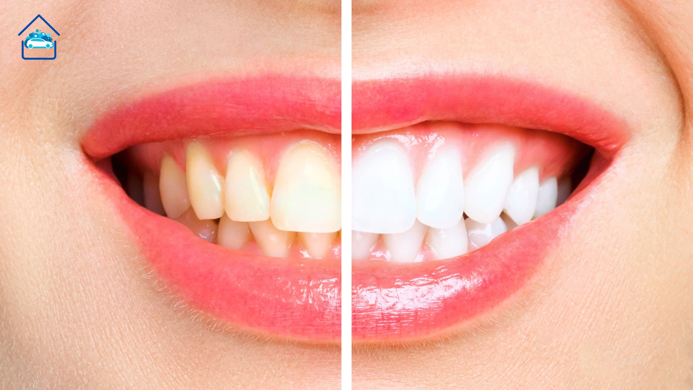 teeth whitening at dentist with insurance